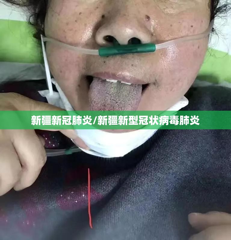 新疆新冠肺炎/新疆新型冠状病毒肺炎 新疆新冠肺炎/新疆新型冠状病毒肺炎