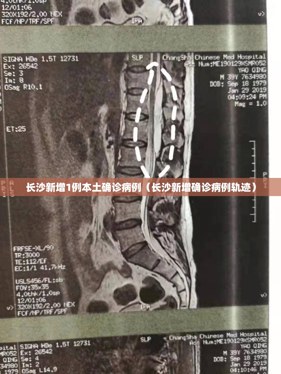 长沙新增1例本土确诊病例(长沙新增确诊病例轨迹) 长沙新增1例本土确诊病例(长沙新增确诊病例轨迹)