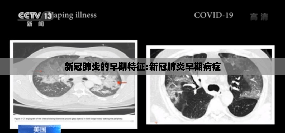 新冠肺炎的早期特征:新冠肺炎早期病症