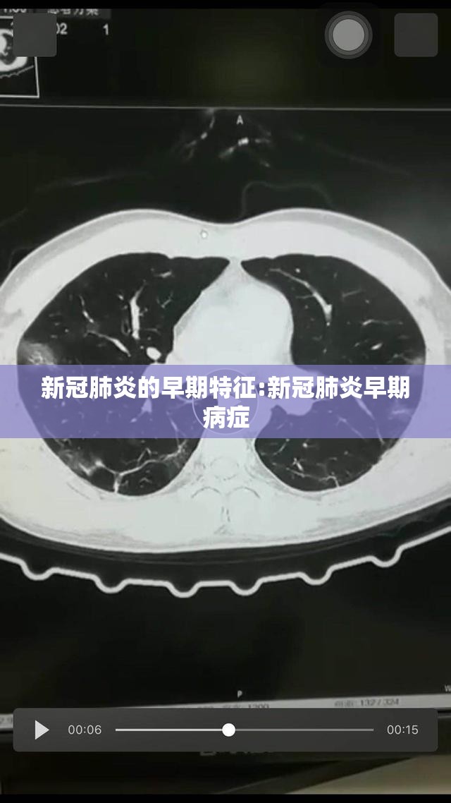新冠肺炎的早期特征:新冠肺炎早期病症