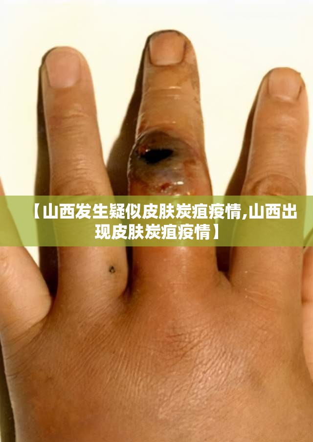 【山西发生疑似皮肤炭疽疫情,山西出现皮肤炭疽疫情】