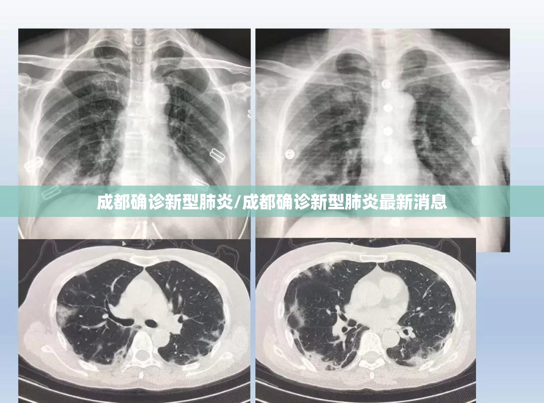 成都确诊新型肺炎/成都确诊新型肺炎最新消息