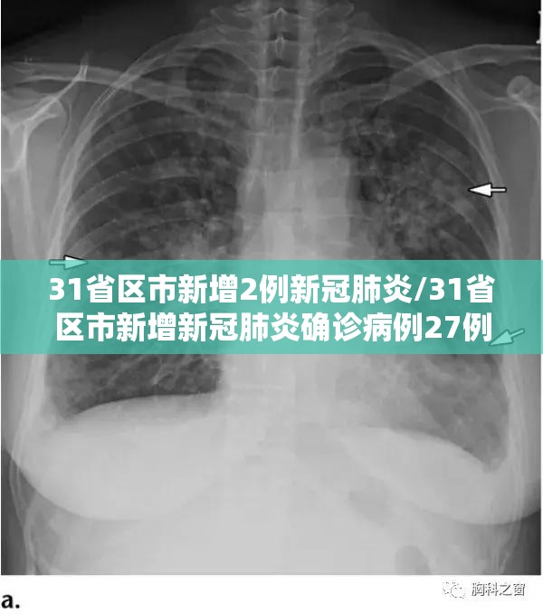 31省区市新增2例新冠肺炎/31省区市新增新冠肺炎确诊病例27例 31省区市新增2例新冠肺炎/31省区市新增新冠肺炎确诊病例27例