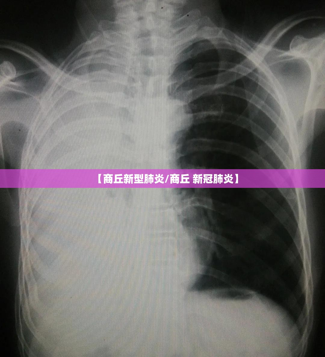 【商丘新型肺炎/商丘 新冠肺炎】