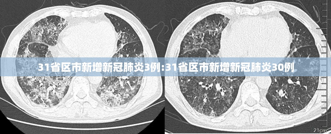 31省区市新增新冠肺炎3例:31省区市新增新冠肺炎30例