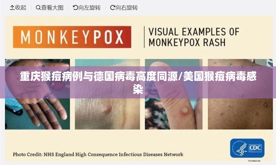 重庆猴痘病例与德国病毒高度同源/美国猴痘病毒感染