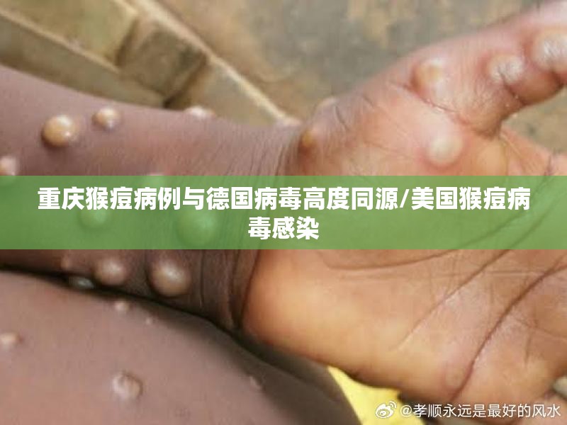 重庆猴痘病例与德国病毒高度同源/美国猴痘病毒感染