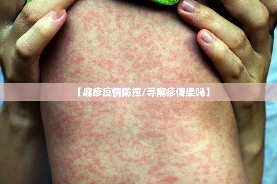 【麻疹疫情防控/寻麻疹传梁吗】 【麻疹疫情防控/寻麻疹传梁吗】