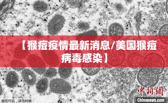 【猴痘疫情最新消息/美国猴痘病毒感染】 【猴痘疫情最新消息/美国猴痘病毒感染】