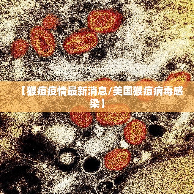 【猴痘疫情最新消息/美国猴痘病毒感染】 【猴痘疫情最新消息/美国猴痘病毒感染】
