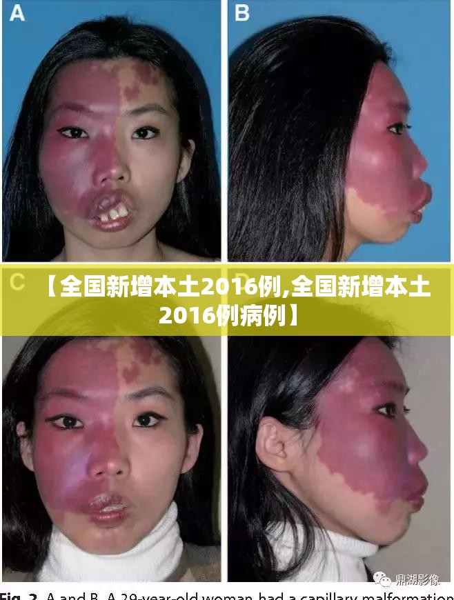 【全国新增本土2016例,全国新增本土2016例病例】 【全国新增本土2016例,全国新增本土2016例病例】