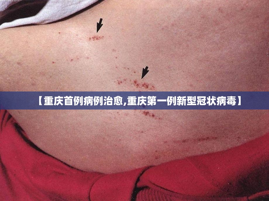 【重庆首例病例治愈,重庆第一例新型冠状病毒】 【重庆首例病例治愈,重庆第一例新型冠状病毒】